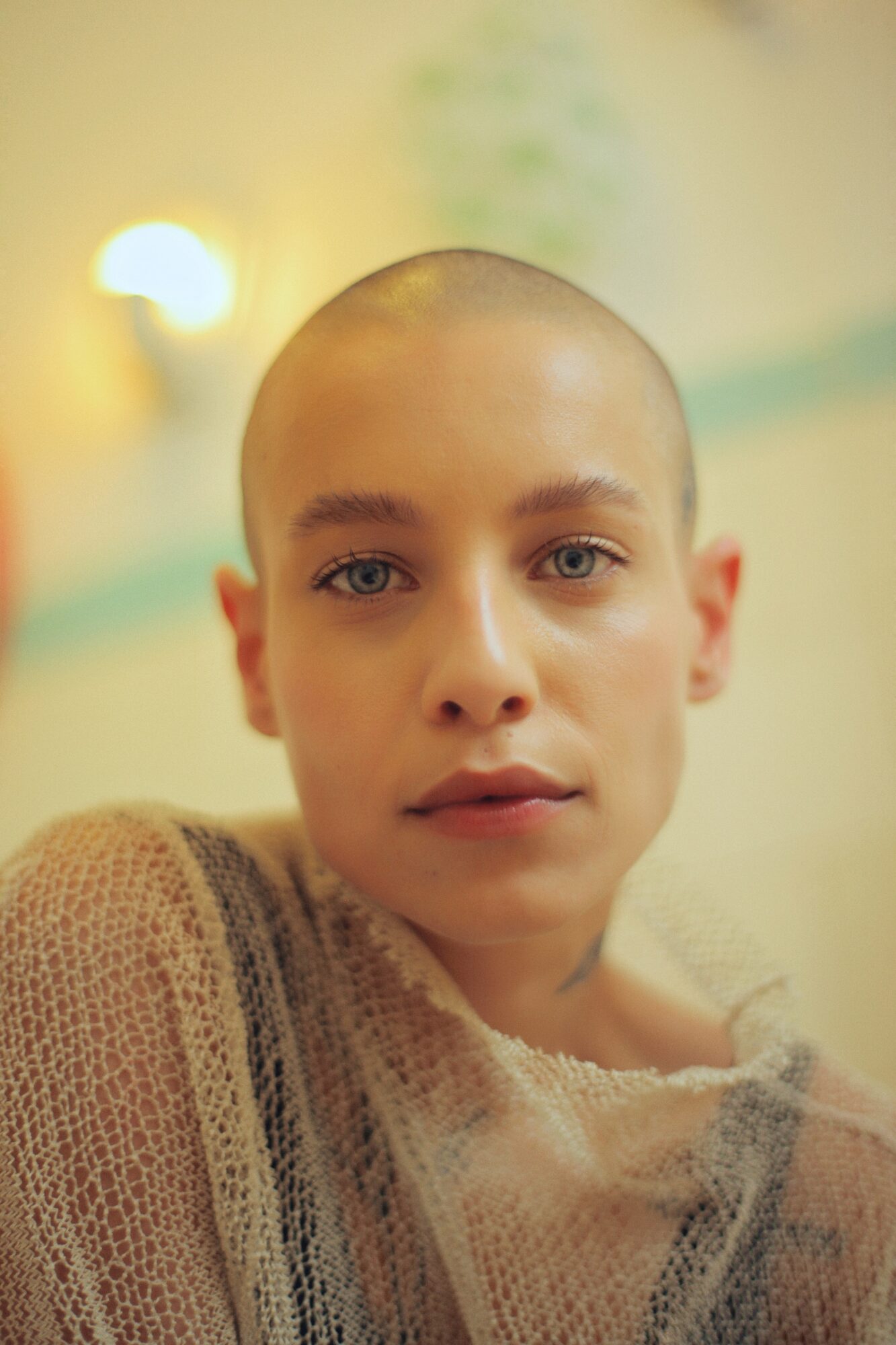 Cas de l'alopécie sévère sans greffe possible. Avez vous pensé à la trichopigmentation. Clinique Rivoli Massena 2 cas de l'alopécie sévère sans greffe de cheveux possible. Avez vous pensé à la trichopigmentation. Clinique Rivoli Massena 2