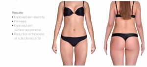 hotsculpting clinique rivoli massena résultats