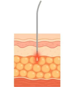L'Endolifting par laser en Médecine Esthétique Clinique Rivoli Massena 6