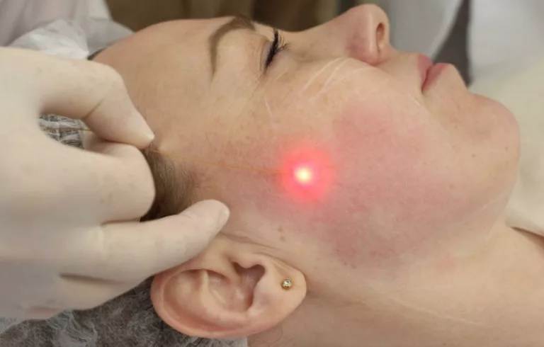 L'endolifting par laser en Médecine Esthétique Clinique Rivoli Massena 9.jpg