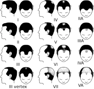 la greffe de cheveux au niveau du vertex Clinique Rivoli Massena 3