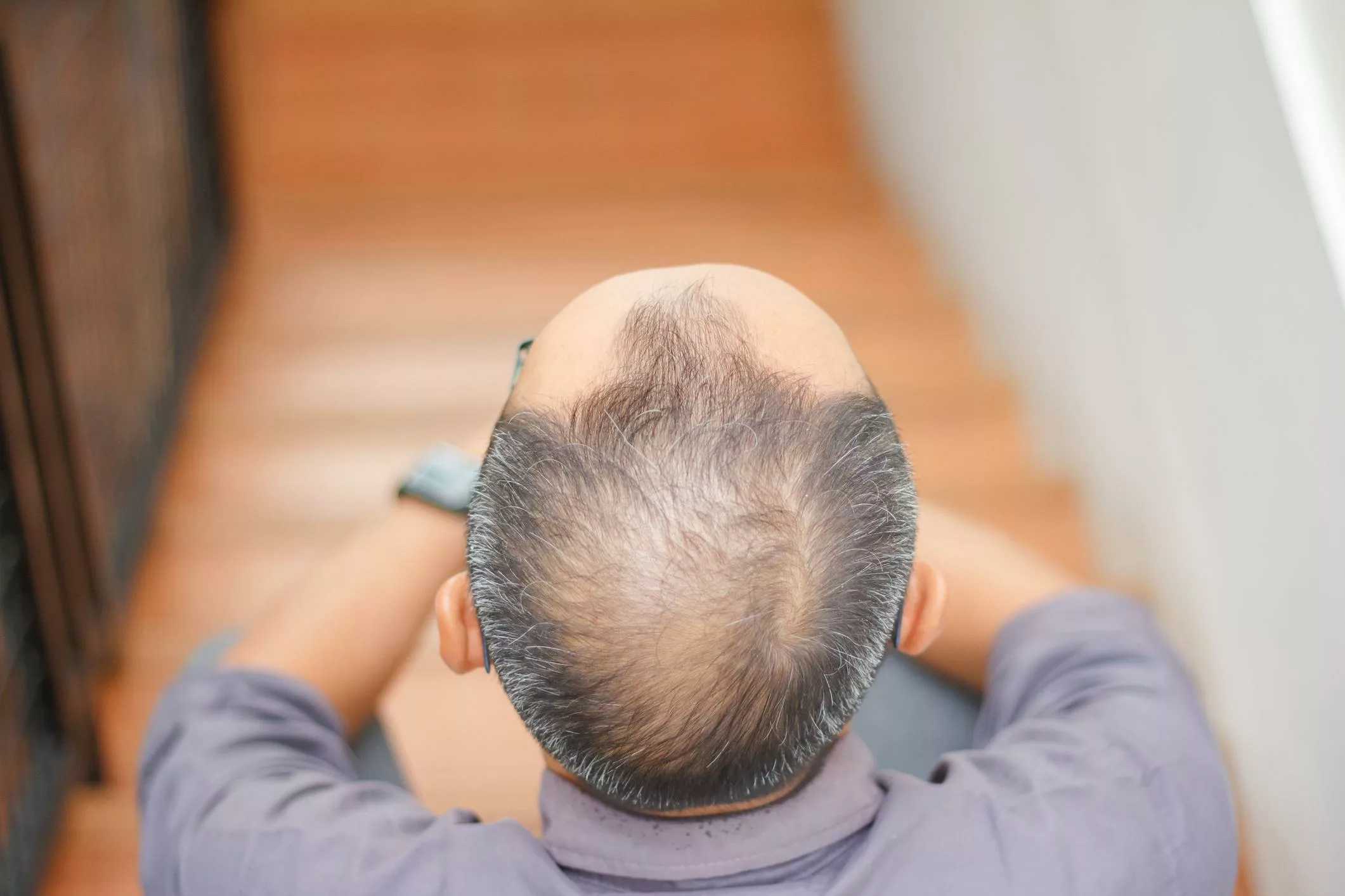 La greffe de cheveux au niveau du vertex Clinique Rivoli Massena 8