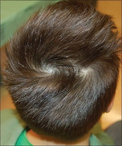 La greffe de cheveux au niveau du vertex Clinique Rivoli Massena
