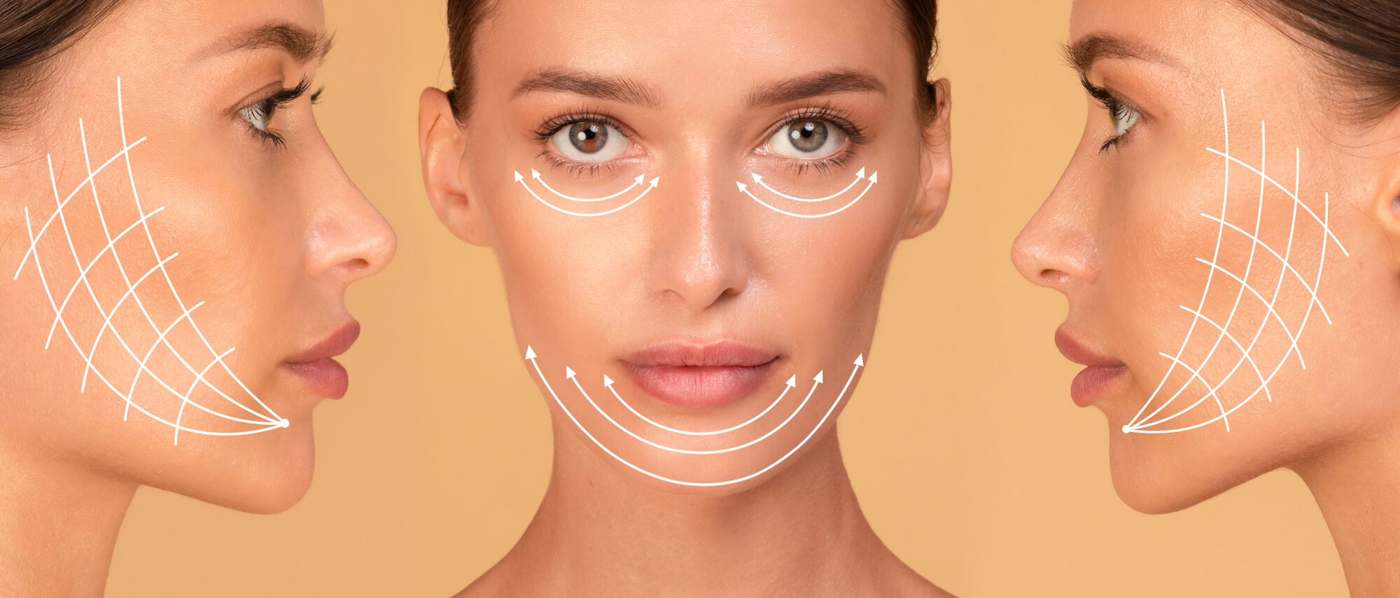 Cosmetology concept. Collage of front and side view portrait of caucasian woman with arrows on face for lifting skin Laser endotight en Medecine Esthetique Clinique Rivoli Massena 2