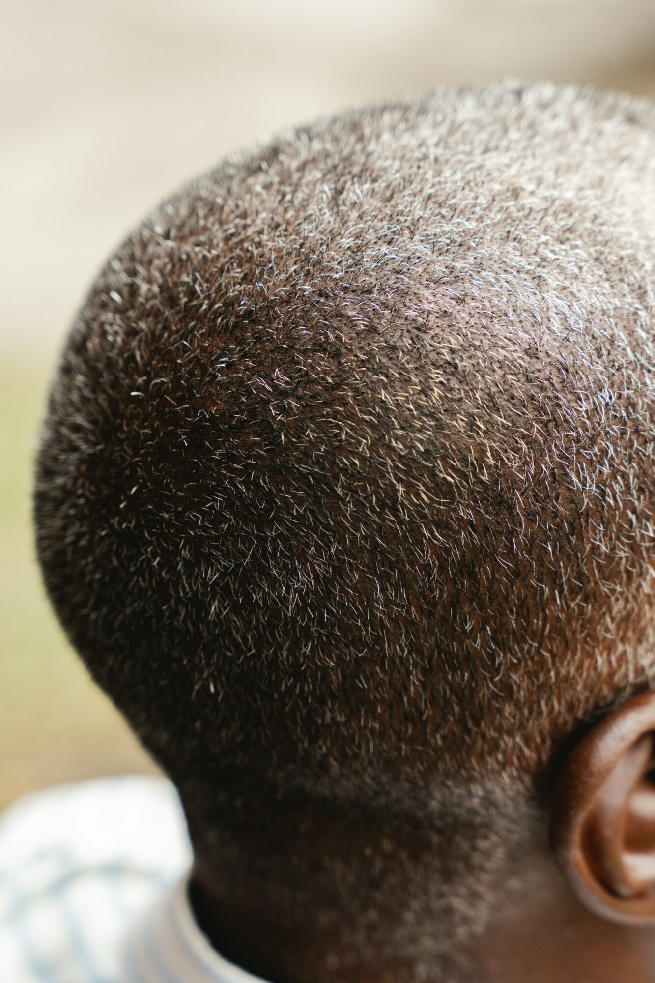 Le PRP cheveux dans le traitement de la pelade et du psoriasis du cuir chevelu Clinique Rivoli Massena 2 le PRP cheveux dans le traitement de la pelade et du psoriasis du cuir chevelu Clinique Rivoli Massena 2