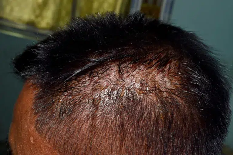 Le danger des greffes de cheveux low cost