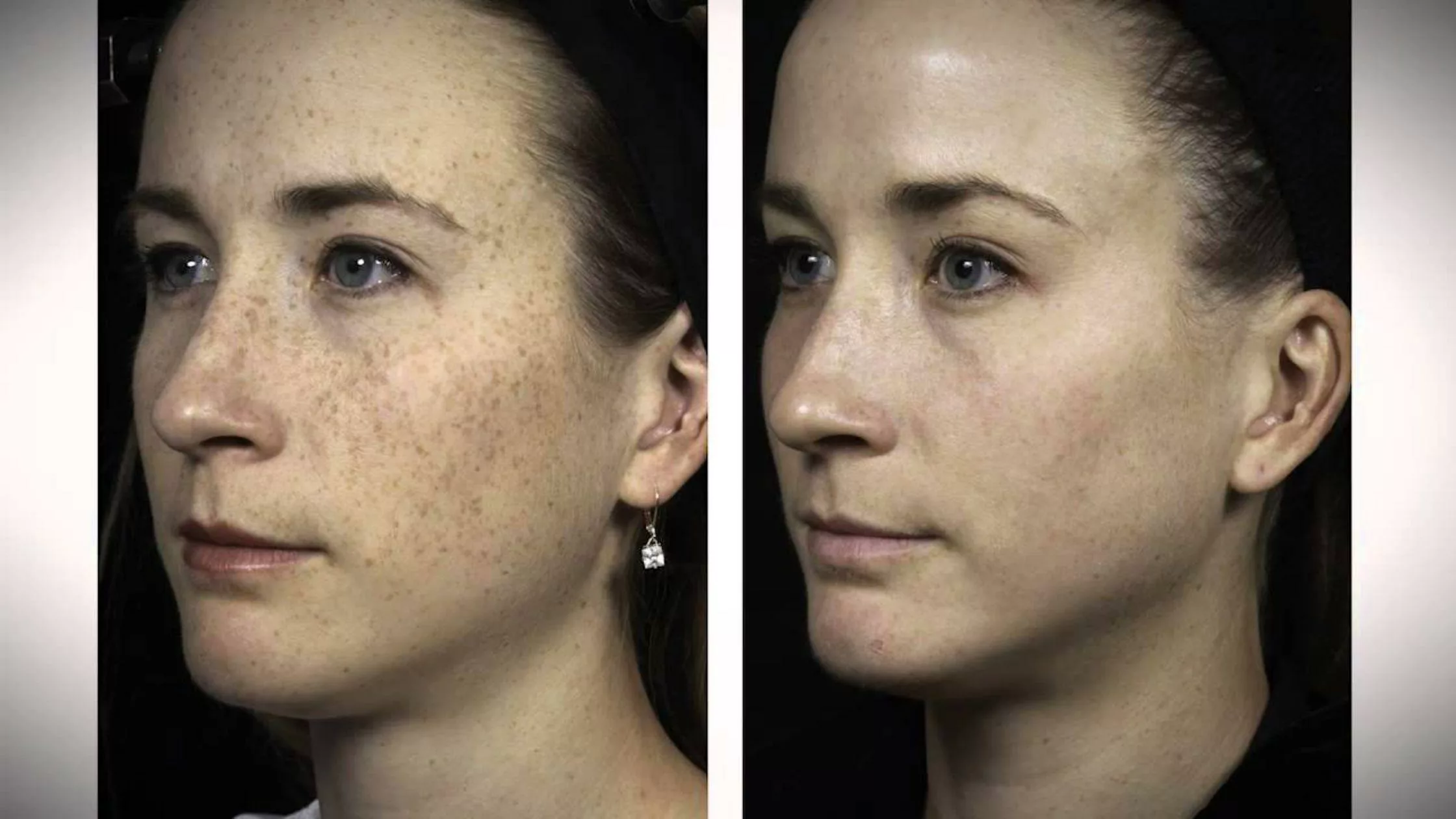 les bienfaits de l'Hydrafacial Clinique Rivoli Massena 2