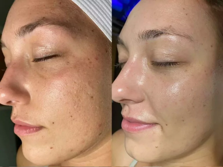 les bienfaits de l'Hydrafacial Clinique Rivoli Massena 3