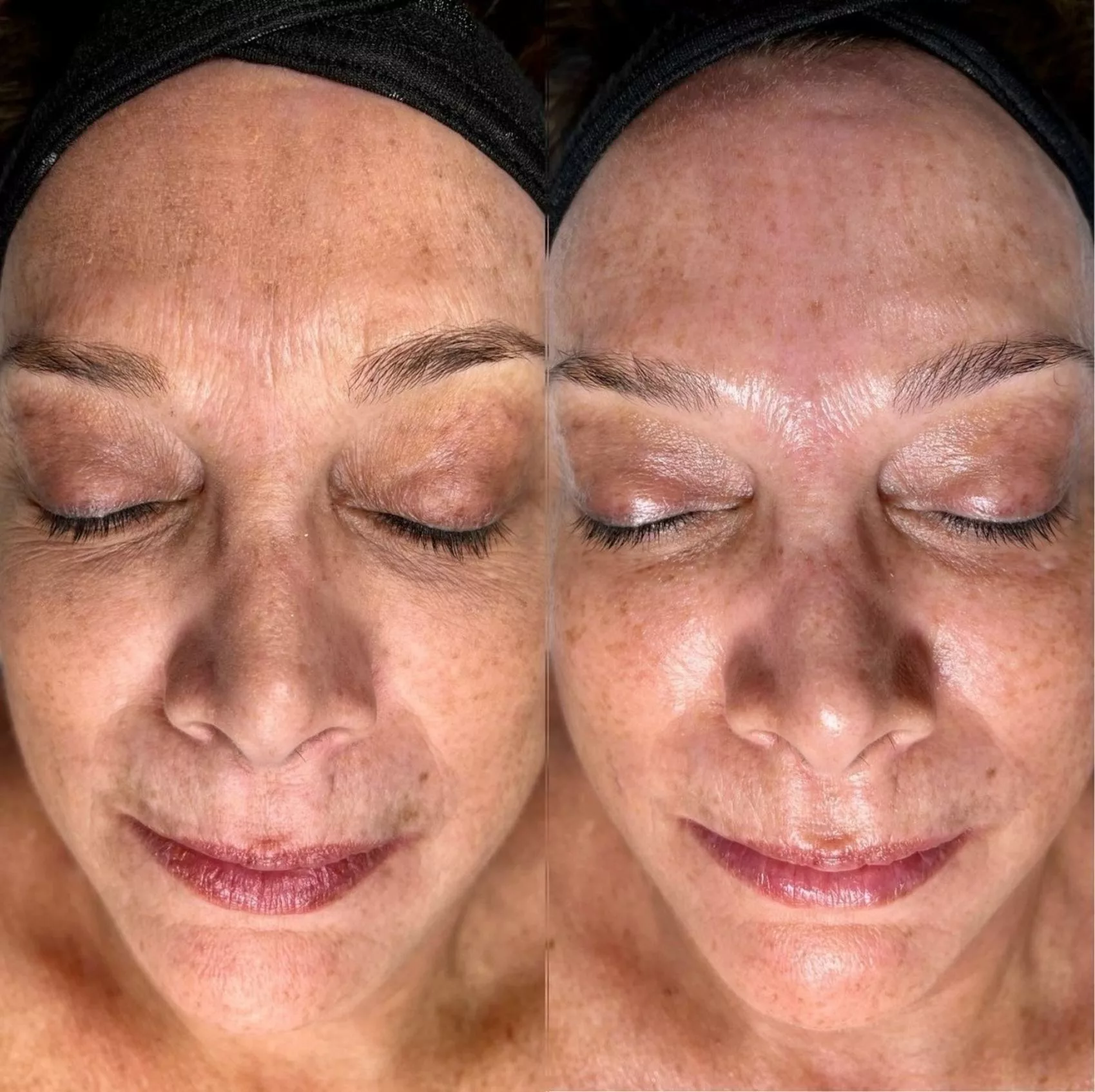 les bienfaits de l'Hydrafacial Clinique Rivoli Massena 4