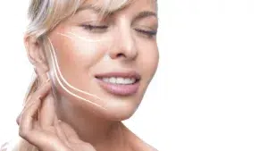 les fils tenseurs en Médecine Esthétique Clinique Rivoli Massena 4