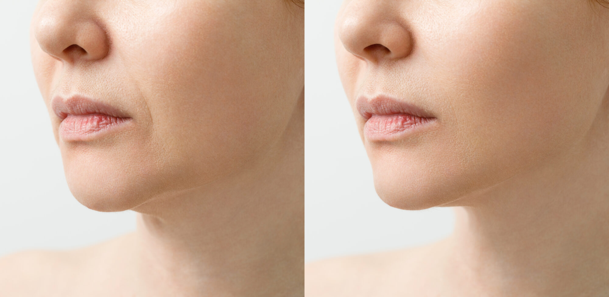 A close portrait of an aged woman before and after facial rejuvenation procedure. Correction of the chin shape liposuction of the neck. The result of the procedure in the clinic of aesthetic medicine. les injections d'acide hyaluronique de la Jawline Clinique Rivoli Massena 2