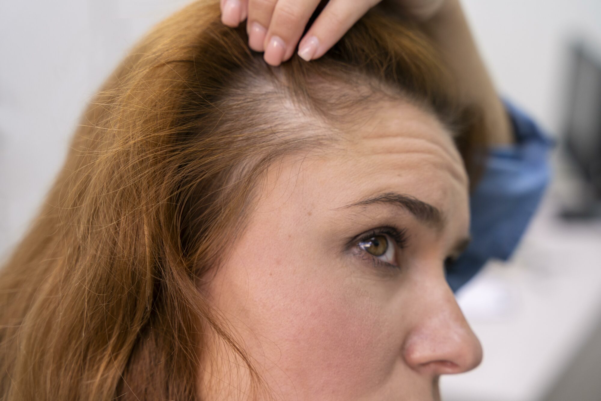Mesotherapie capillaire PRP cheveux comment choisir Clinique Rivoli Massena 3