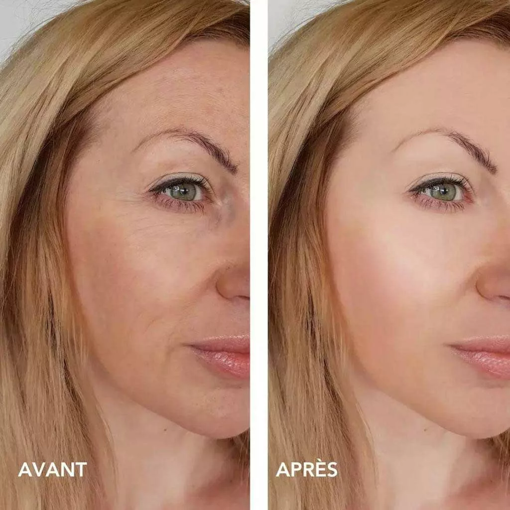 Avant / après injection Rejuran à Strasbourg
