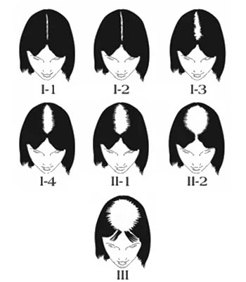 chute-cheveux-femme-strasbourg Evaluation calvitie femme