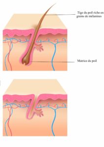 epilation laser definitive en dix questions clinique rivoli massena 2