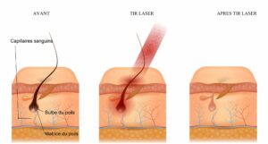 epilation laser peau foncée clinique rivoli massena 8