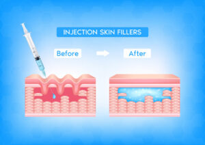 les injections d'Acide Hyaluronique focus sur ce qui révolutionné la Médecine Esthétique Clinique Rivoli Massena 18