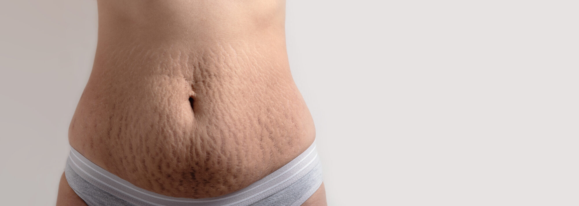 skin stretch marks vergetures clinqiue rivoli massena 2